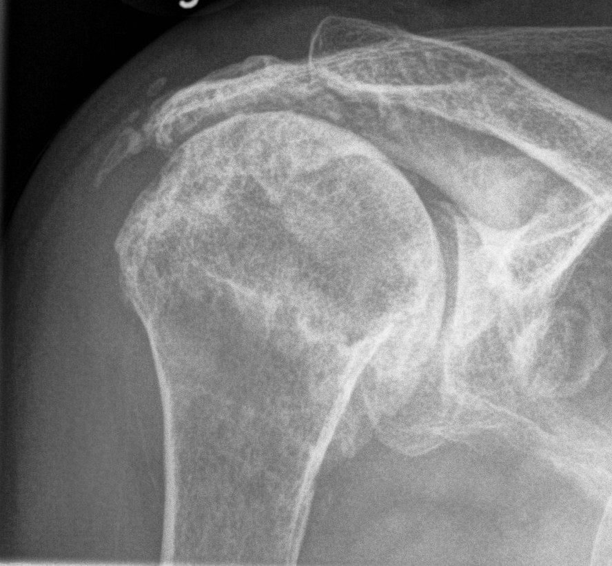 Rotator Cuff Arthropathy for Reverse TSR